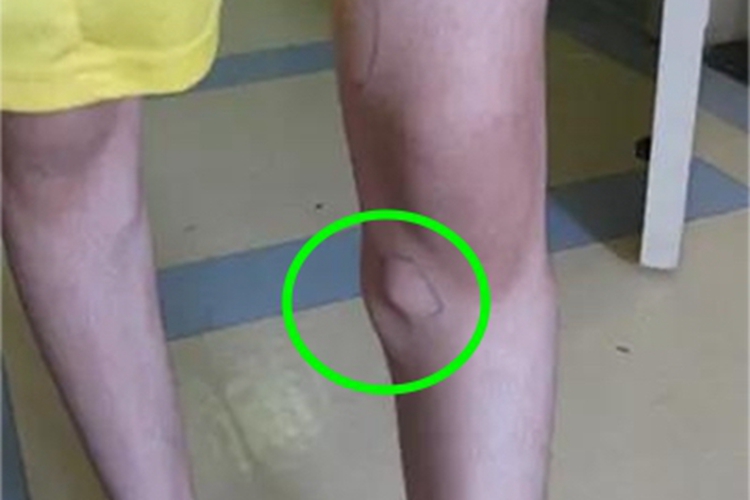 多发性骨软骨瘤腿症状图 多发性骨软骨瘤腿症状图