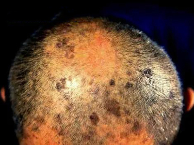 脂溢性角化病头皮长很多黑色的斑图
