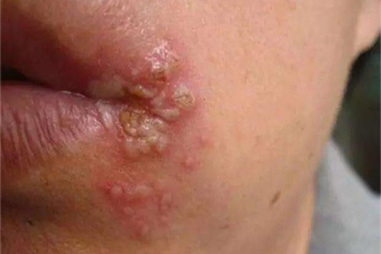 感染性口角炎嘴唇结痂图