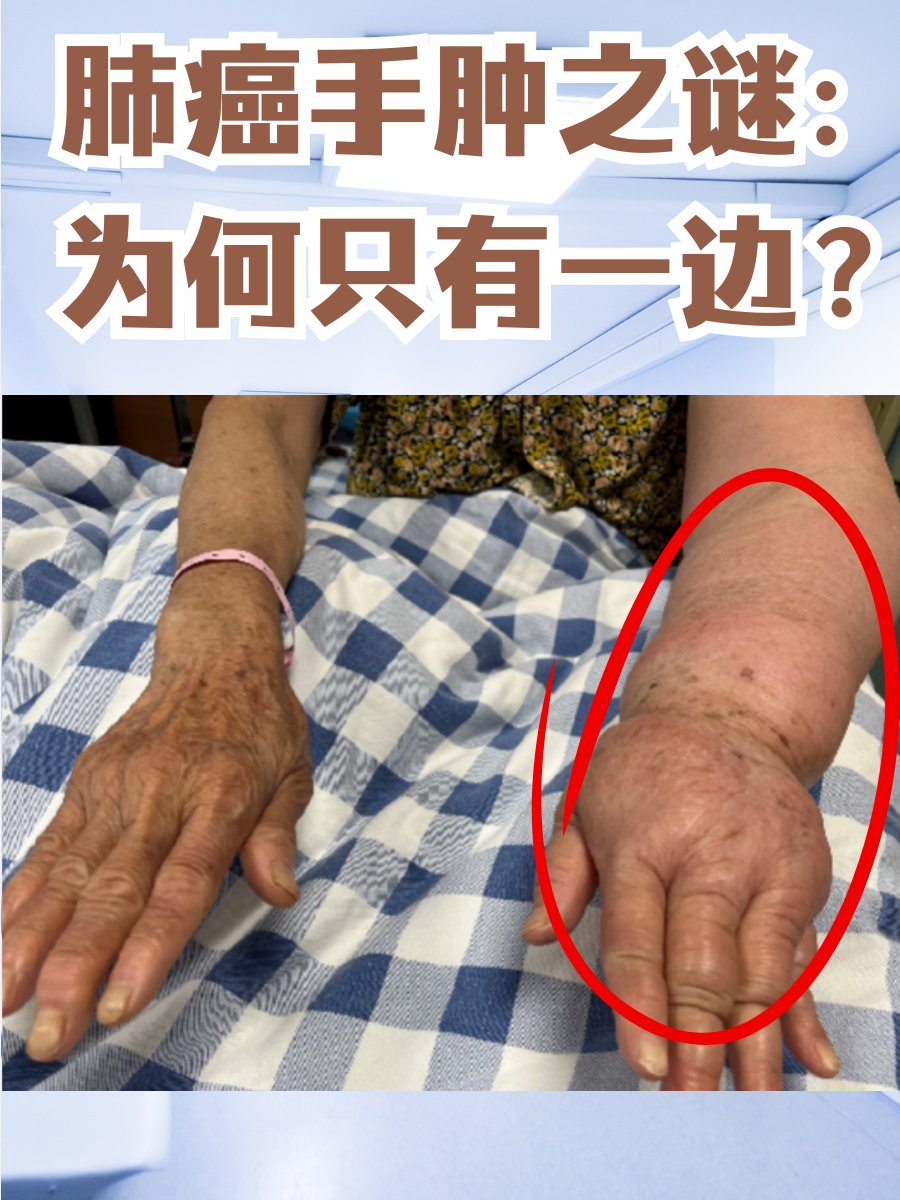 肺癌手肿之谜：为何只有一边？