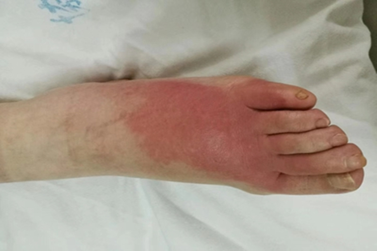 急性湿疹脚背红斑图 急性湿疹脚背红斑图