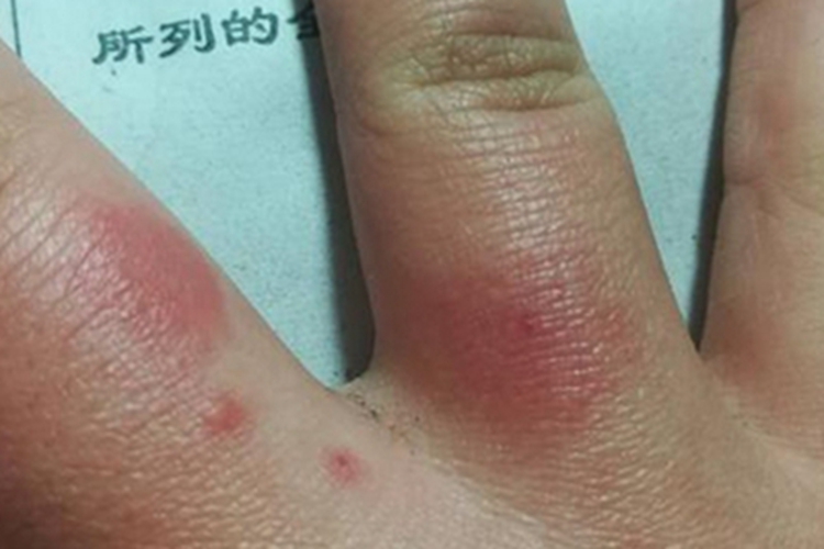 皮肤过敏红肿手指红肿图