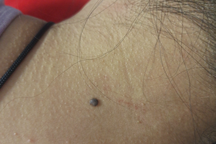 皮内痣结节图 皮内痣结节图