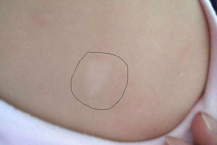 婴儿胸前白癜风图