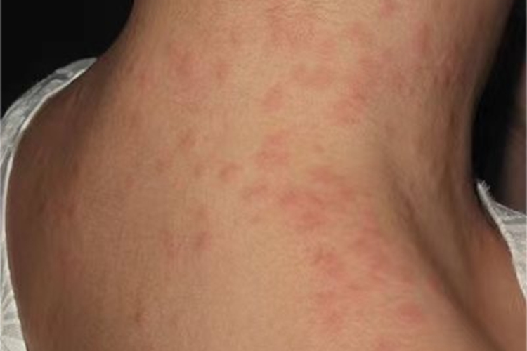 毛虫皮炎肩部丘疹症状图 毛虫皮炎肩部丘疹症状图