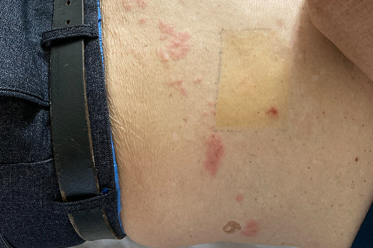 带状疱疹的丘疹图