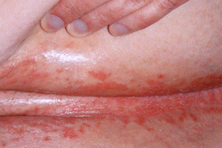 念珠菌性间擦疹大腿根部红疹子图