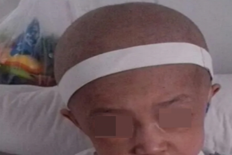 β地中海贫血头颅变大图