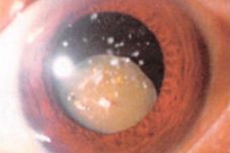 皮质性白内障眼球混浊图