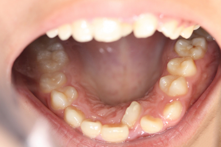 扭转牙正畸前图