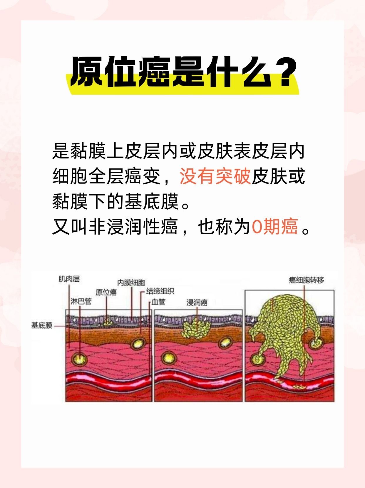 深度解读-原位癌是什么意思？怎么办？