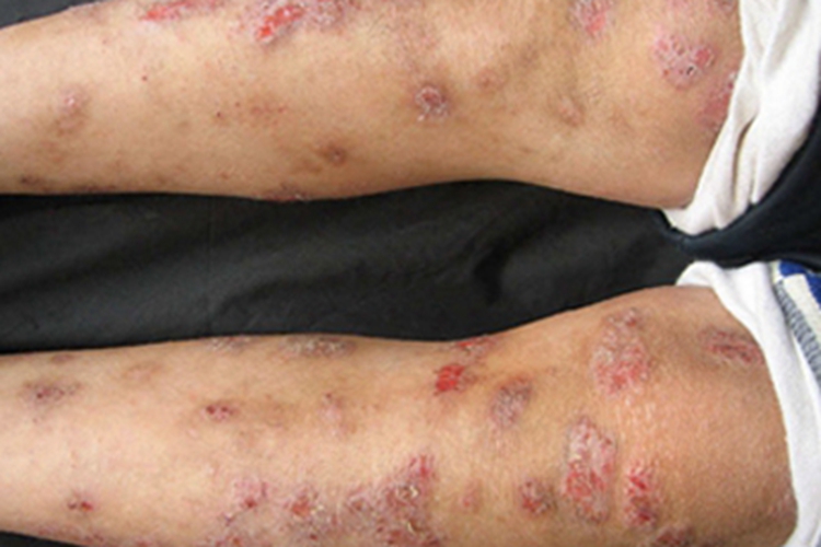儿童期特应性皮炎小腿糜烂图 儿童期特应性皮炎小腿糜烂图