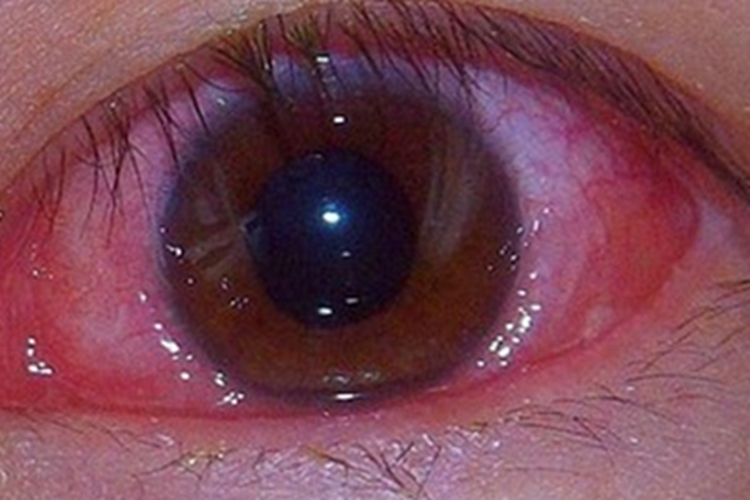 常年性过敏性结膜炎结膜充血图 常年性过敏性结膜炎结膜充血图