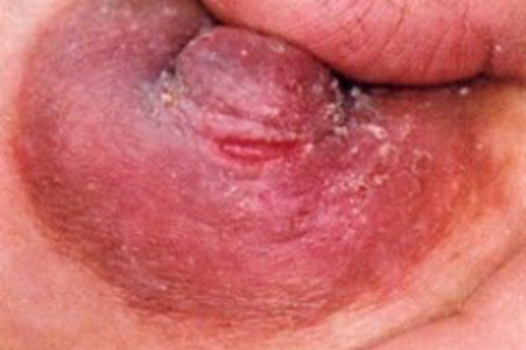 乳头皲裂裂口图