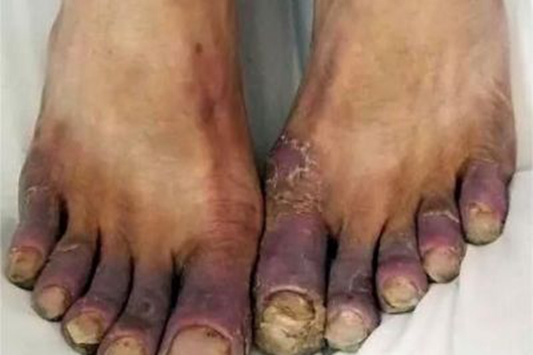 副肿瘤性肢端角化症脚趾发紫图 副肿瘤性肢端角化症脚趾发紫图