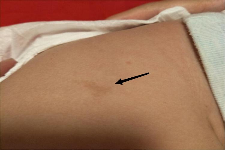 咖啡斑腹部症状图