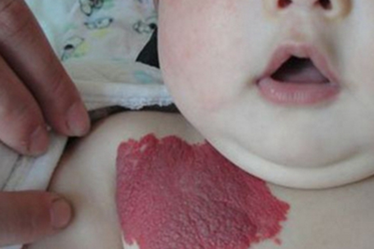 浅表型婴儿血管瘤胸部症状图 浅表型婴儿血管瘤胸部症状图