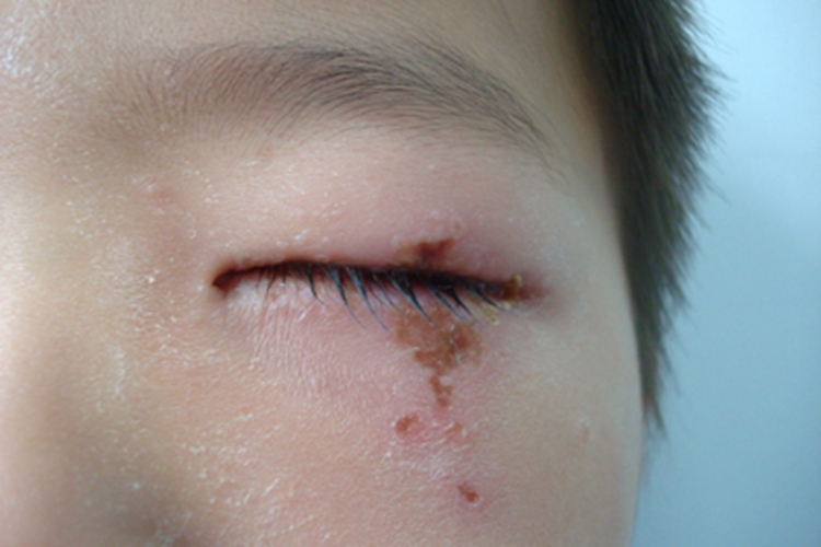 慢性湿疹面部脱皮图