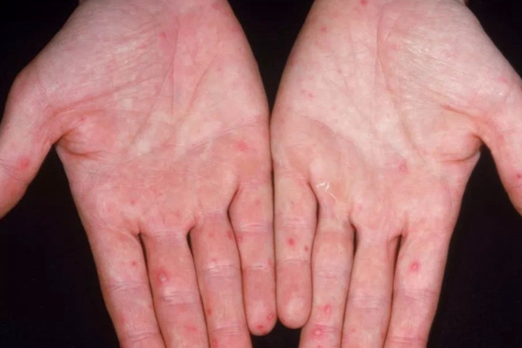 手足口病手指上起小红疙瘩图 手足口病手指上起小红疙瘩图