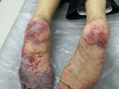 静脉曲张性溃疡脚底乌紫色斑状分布图.jpg