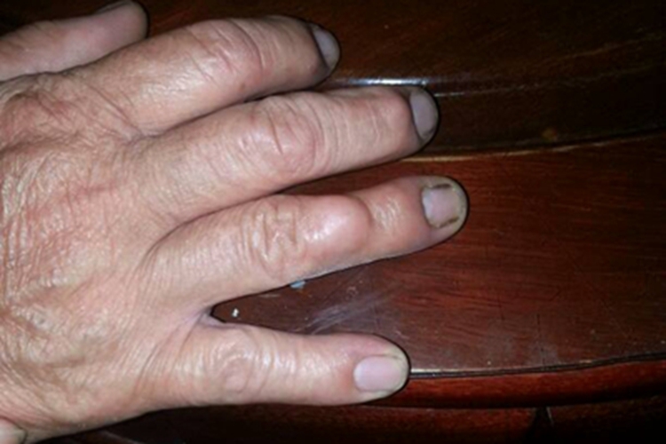 腱鞘巨细胞瘤手指肿块图