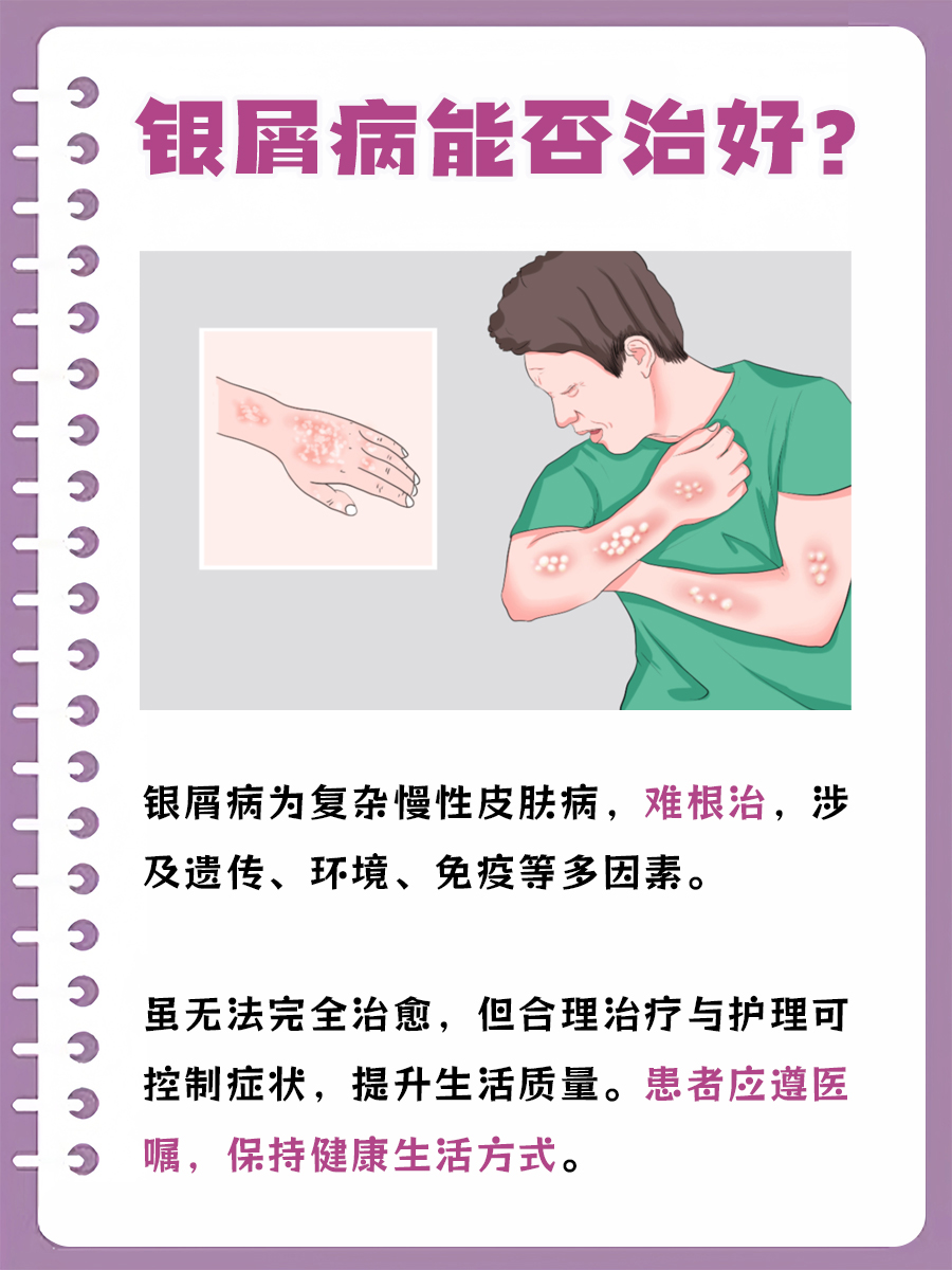 银屑病能治好吗？你必须知道
