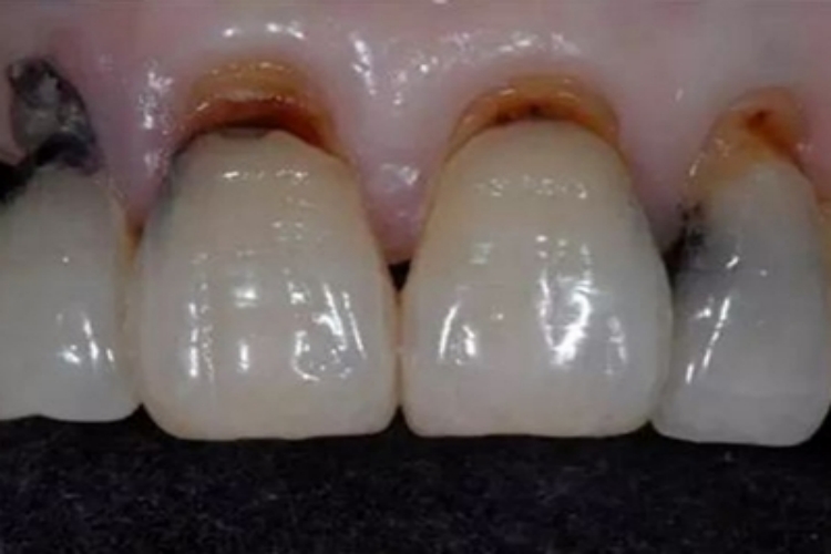 楔状缺损牙龈萎缩发黑图