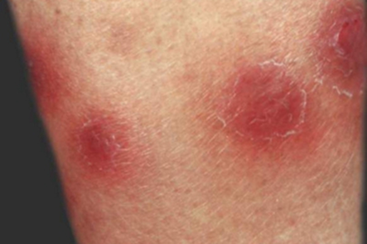 硬红斑小腿圆形红斑图