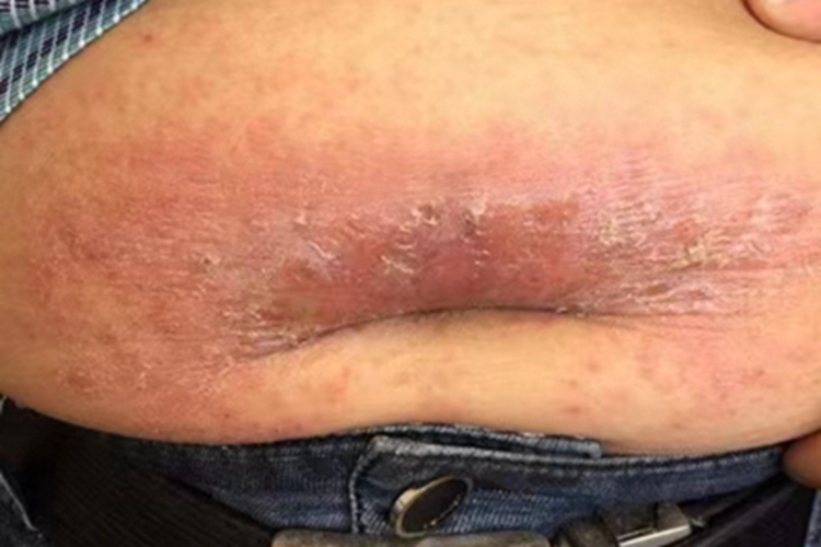 皮革皮炎腹部红肿图