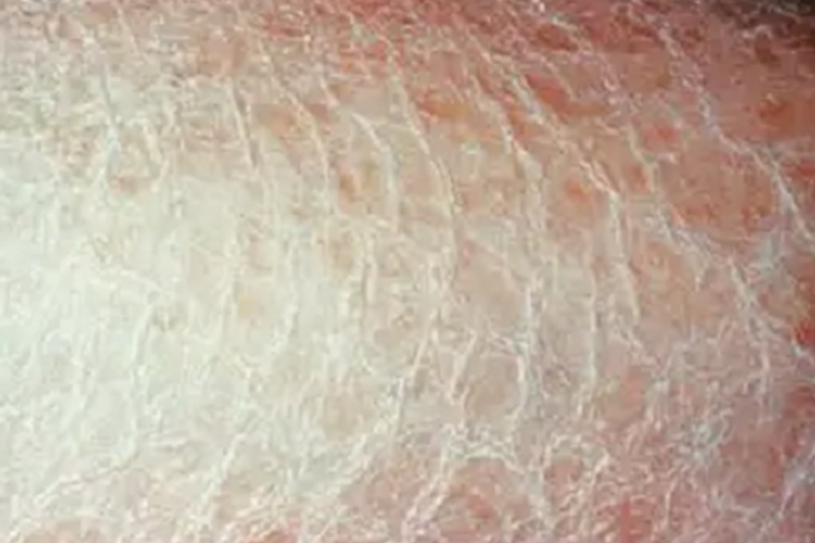 中度裂纹图 中度裂纹图