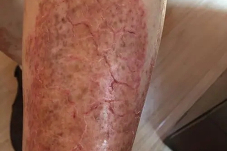 皲裂性湿疹裂口图