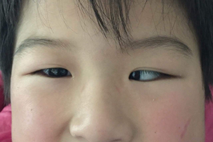 内斜视眼部畸形图 内斜视眼部畸形图