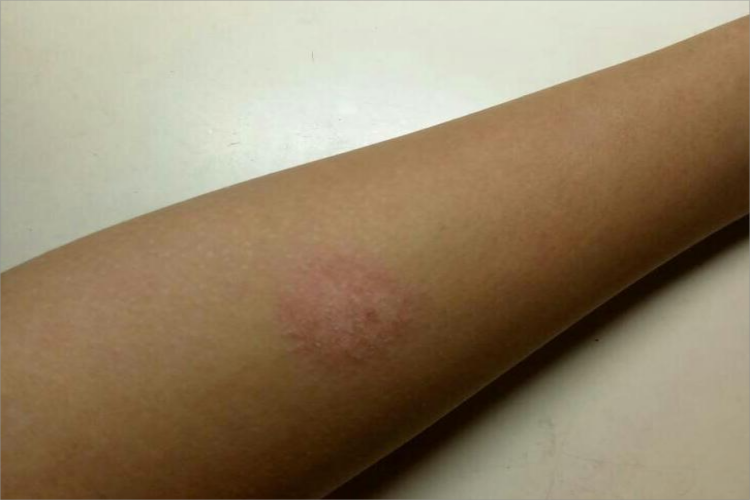 体癣胳膊症状图