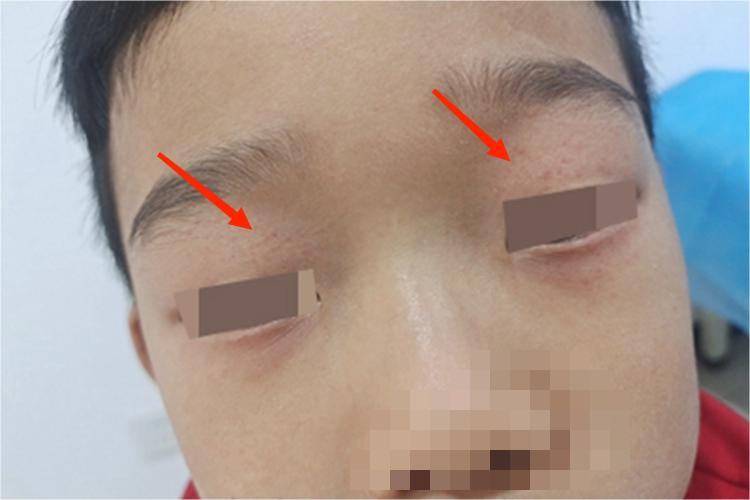 血管内压力增多性紫癜紫斑图 血管内压力增多性紫癜紫斑图