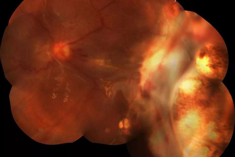 小孩脉络膜破裂图