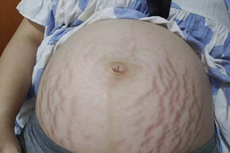 萎缩纹肚子一圈爬满了红纹图