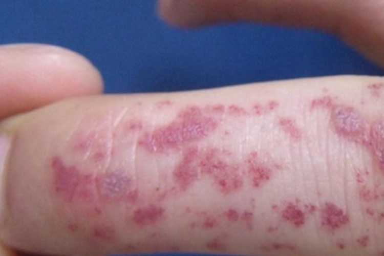 血管角化瘤手部紫斑图