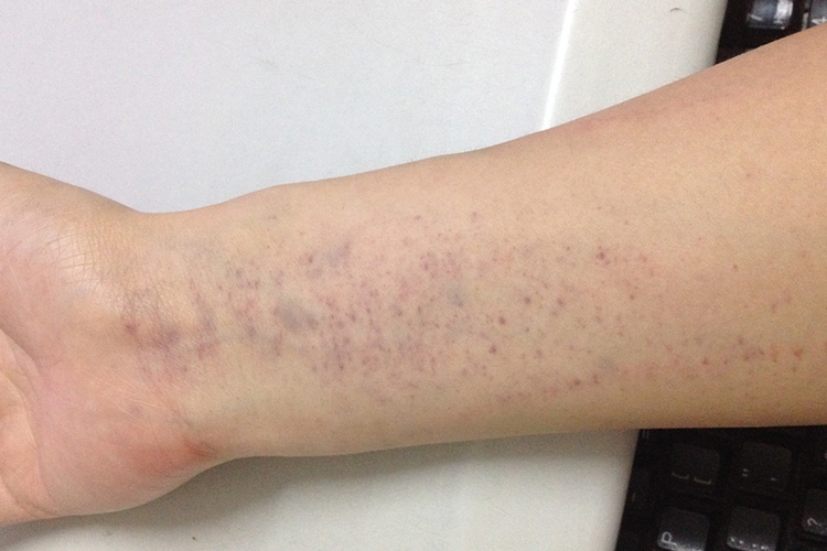 单纯性紫癜图 单纯性紫癜图