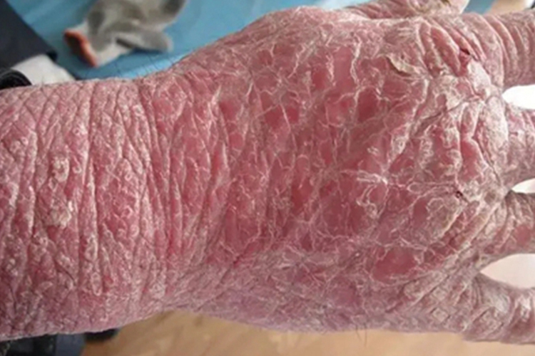 红皮病脱屑期手背皮肤粗糙图