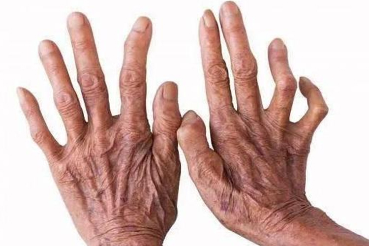 麻风病爪形手图