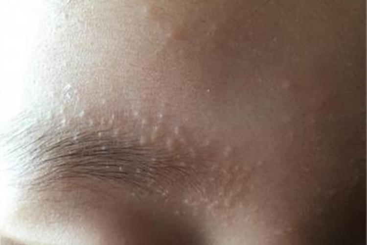 新生儿皮脂腺增生眉毛症状图 新生儿皮脂腺增生眉毛症状图