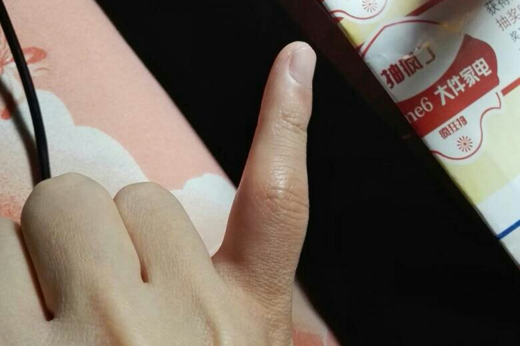 小拇指错位骨头凸起图 小拇指错位骨头凸起图