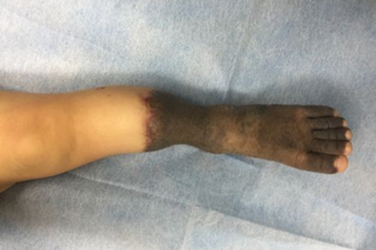 先天性巨痣一只脚变黑图