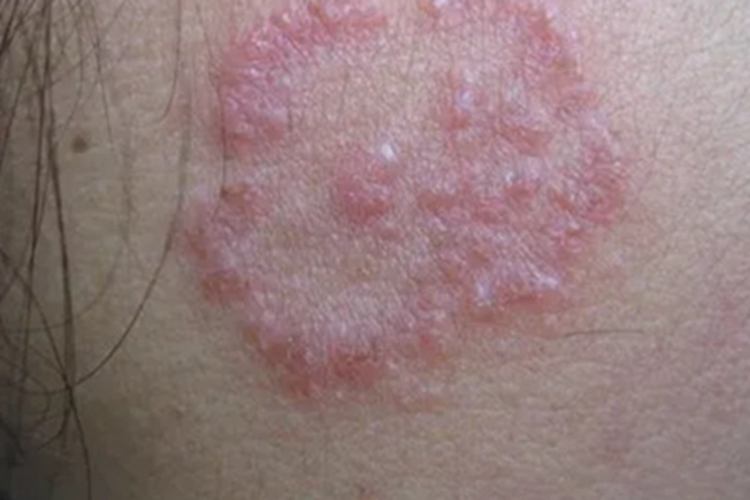 远心性环状红斑面部小水疱图