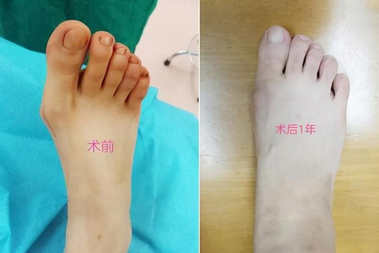 微创拇外翻手术前后图