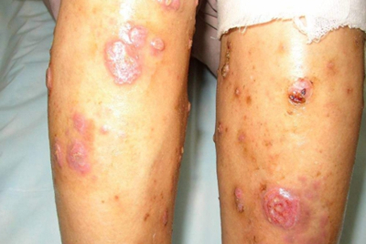 男性扁平湿疣硬疙瘩图 男性扁平湿疣硬疙瘩图