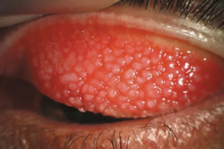 滤泡性结膜炎水疱图