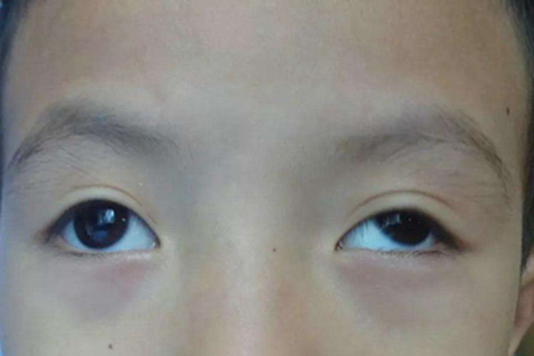 恒定性外斜视眼球变形图