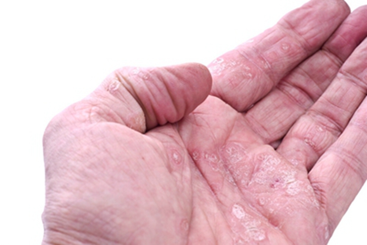 红皮病脱屑期手掌脱皮图