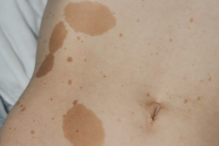 腹部咖啡牛奶斑图